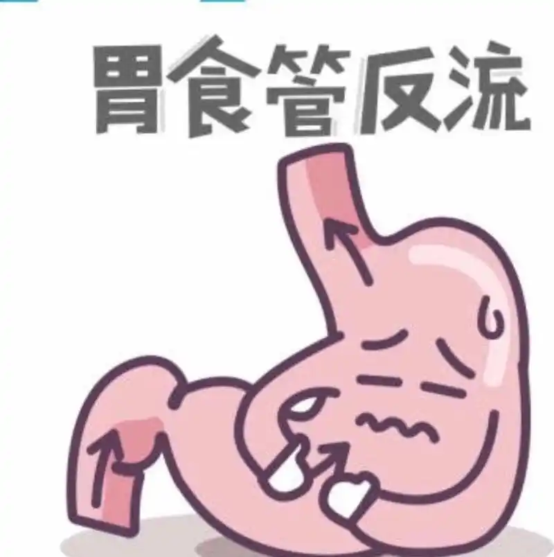 胃食管反流病（